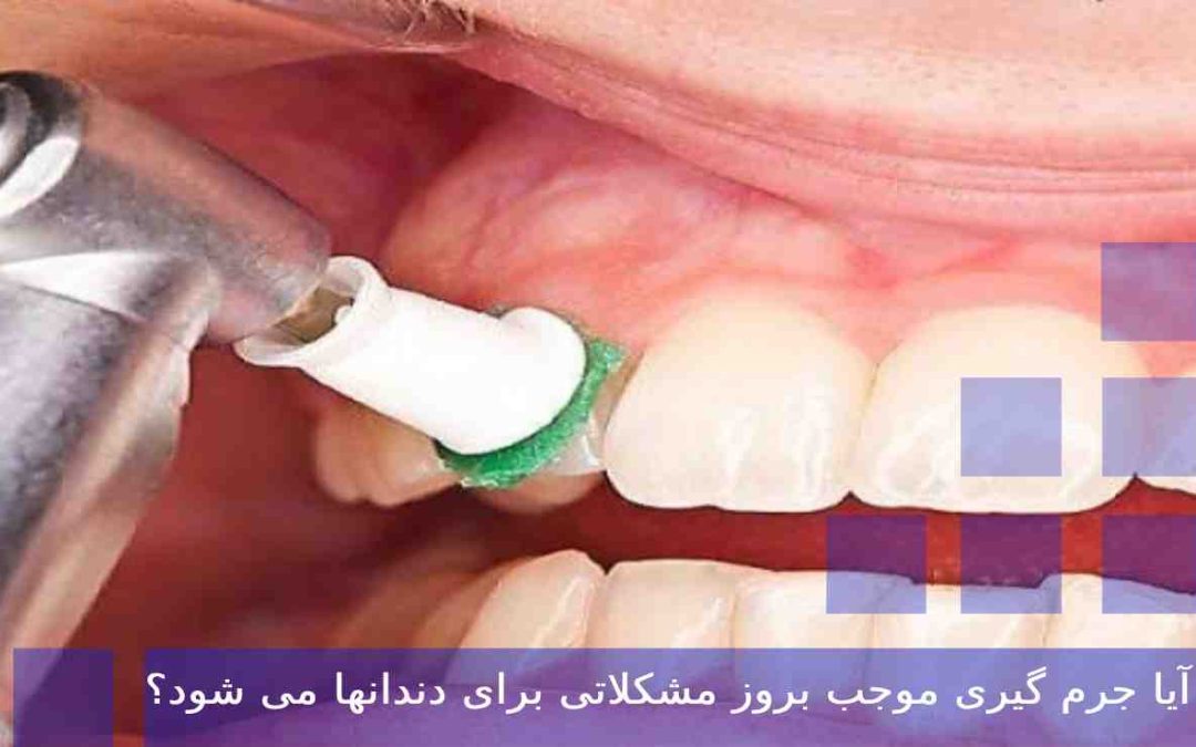 آیا جرم گیری موجب بروز مشکلاتی برای دندانها می شود؟