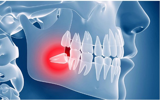 آنچه درباره جراحی دندان نهفته و دندان عقل باید بدانید