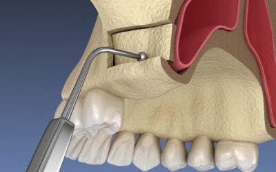 جراحی سینوس لیفت و ایمپلنت و پیوند استخوان